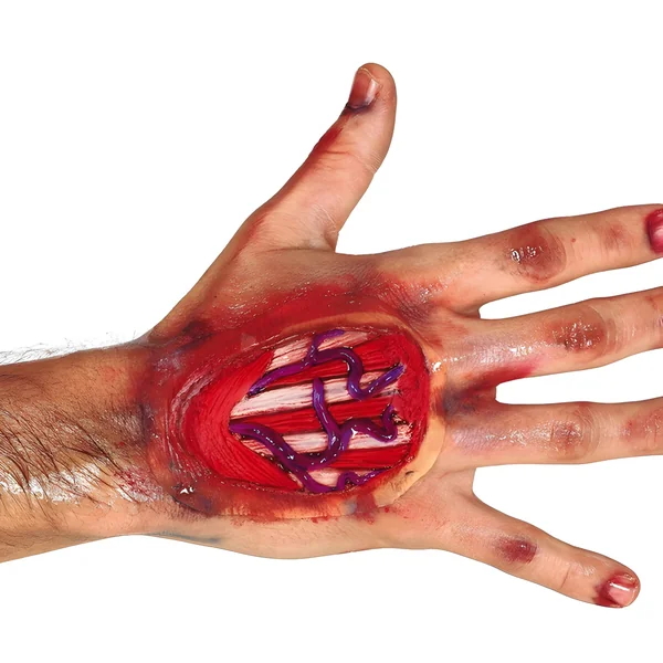 Cicatriz de tendones de mano con adhesivo